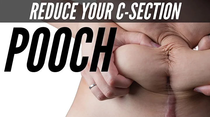 Say Goodbye to C-Section Belly Pouch with Scar Massage