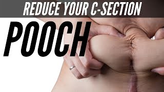 How To Reduce C-Section Belly Pouch Reduce C-Section Bulge With Scar Mage
