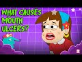 What Causes Mouth Ulcers Painful Mouth Sores Explained Oral Health Facts Dr Binocs Show What Causes Mouth Ulcers Painful Mouth Sores Explained Oral Health Facts Dr Binocs Show