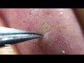 鼻角栓126 nose blackheads★tweezers only★