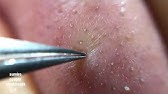 鼻角栓121 2nose Blackheads Larger Version Tweezerz Only Youtube 鼻角栓121 2nose Blackheads Larger Version Tweezerz Only Youtube