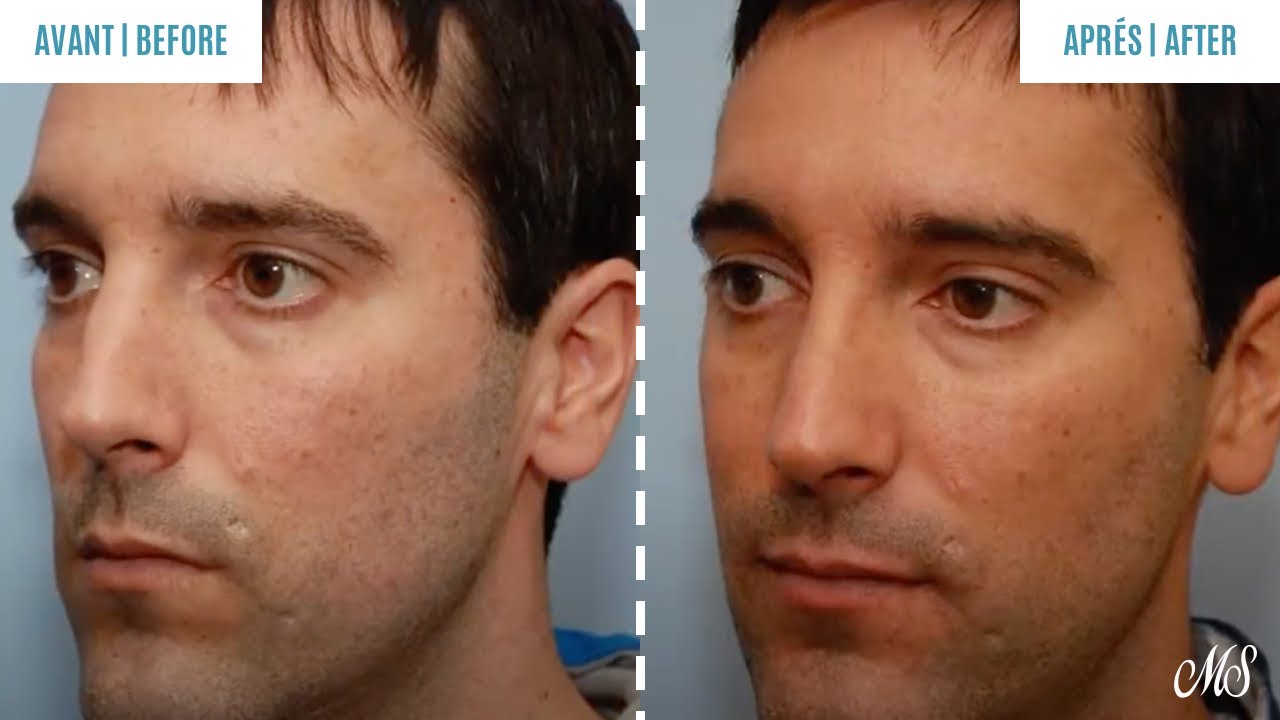 Rhinoplasty Questions to Ask Dr. Mark Samaha, chirurgie plastique faciale à Montréal. YouTube