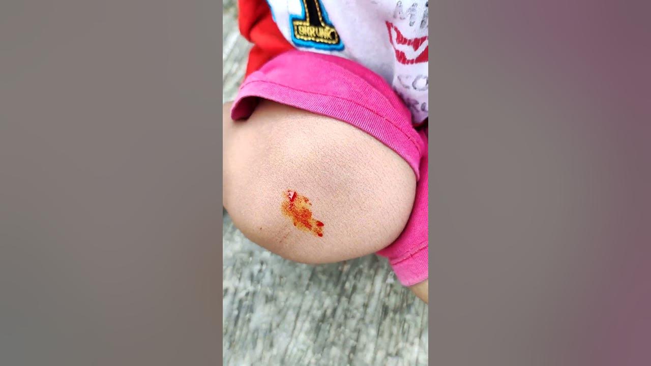 deffan kakinya luk4 karna j4tuh dari m0bil m0bil4n😱😭 #shorts