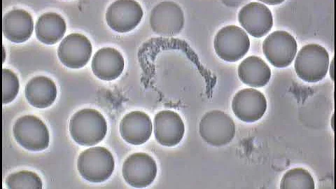 Blood Analysis 1 HMG