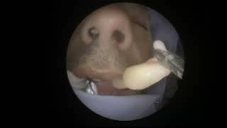 Nasal polyp endoscopic removal