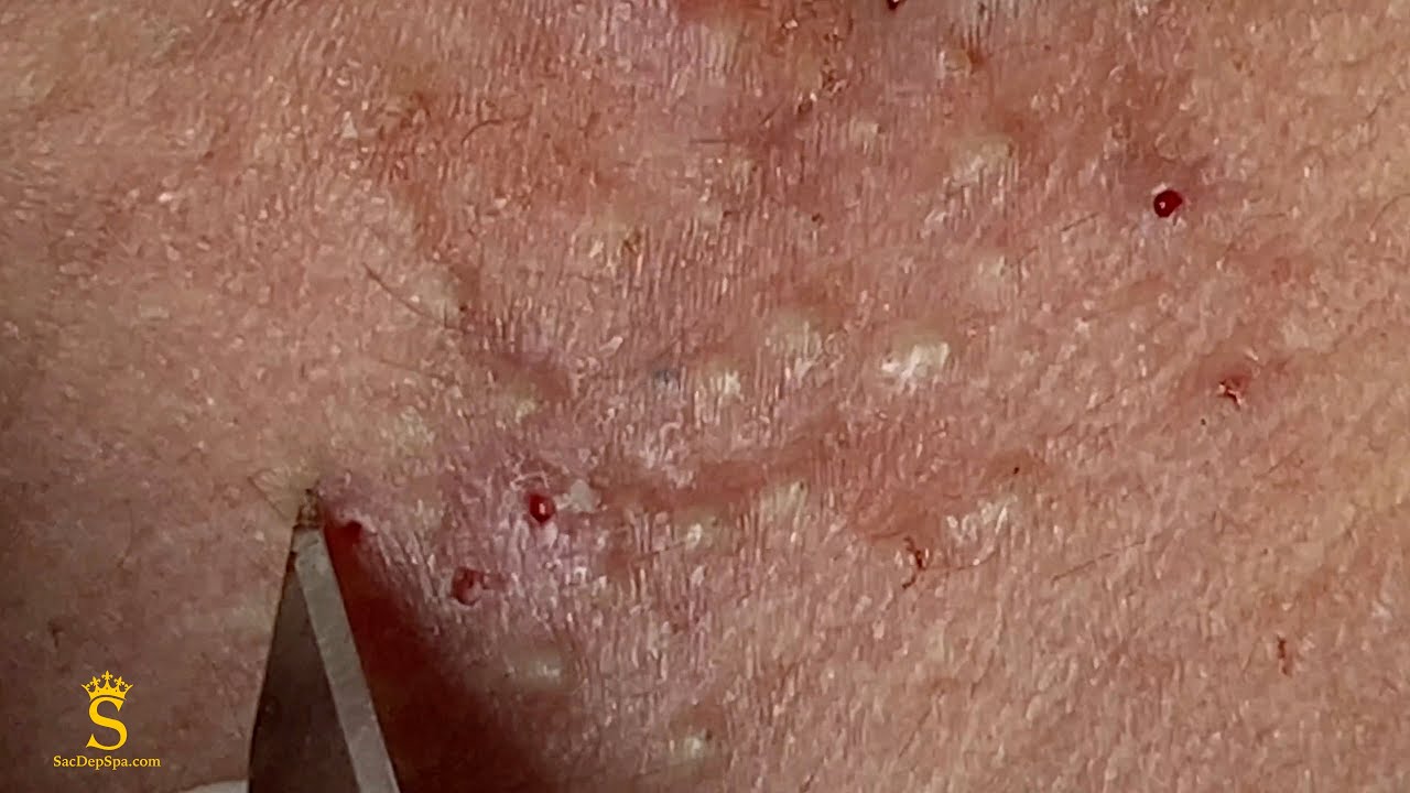 Acne Treatment For "Hung" (P9) | Điều Trị Mụn Cho Hùng (P9) - SacDepSpa#204