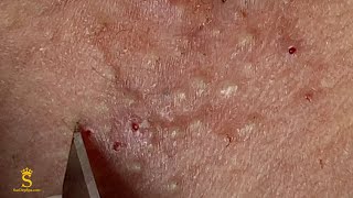 Acne Treatment For
