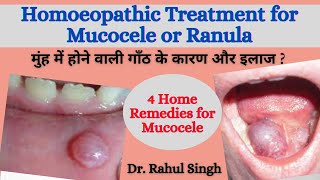 Dr Rahul Singh Homeopathic Physician Health Coach Treatment And Cure Of Mucocele And Ranula With Homoeopathic Medicines Updated In 2021