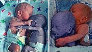 A Nurse places a healthy baby next to a dying twin and what happened left everyone speechless by HappyWorld 692 views 1 month ago 8 minutes, 18 seconds