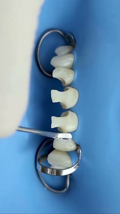 Smile transformation with composite resins. Work by Dr Rafael Sampaio and Dr Adriano Corrêa