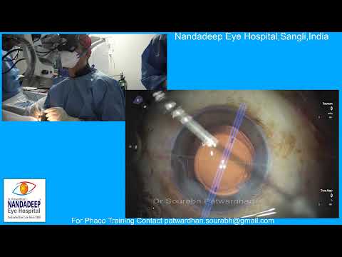 Toric IOL Dr Sourabh Patwardhan Cataract Surgeon from Nandadeep Eye Hospital, Sangli,India