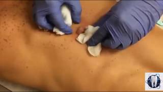 Drainage of Infected Epidermal Cyst