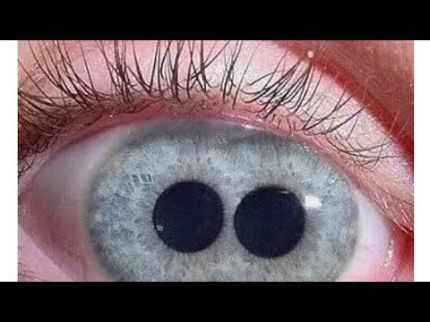 30+ Beautiful Genetic Mutations in Humans