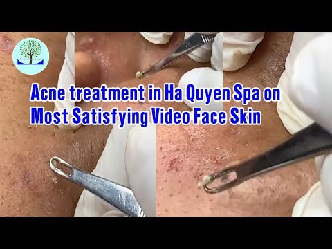 Acne treatment in Ha Quyen Spa on Most Satisfying Video Face Skin