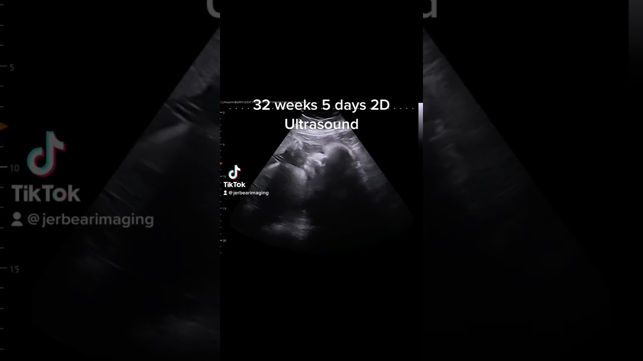 32 weeks 5 days 2D Ultrasound 