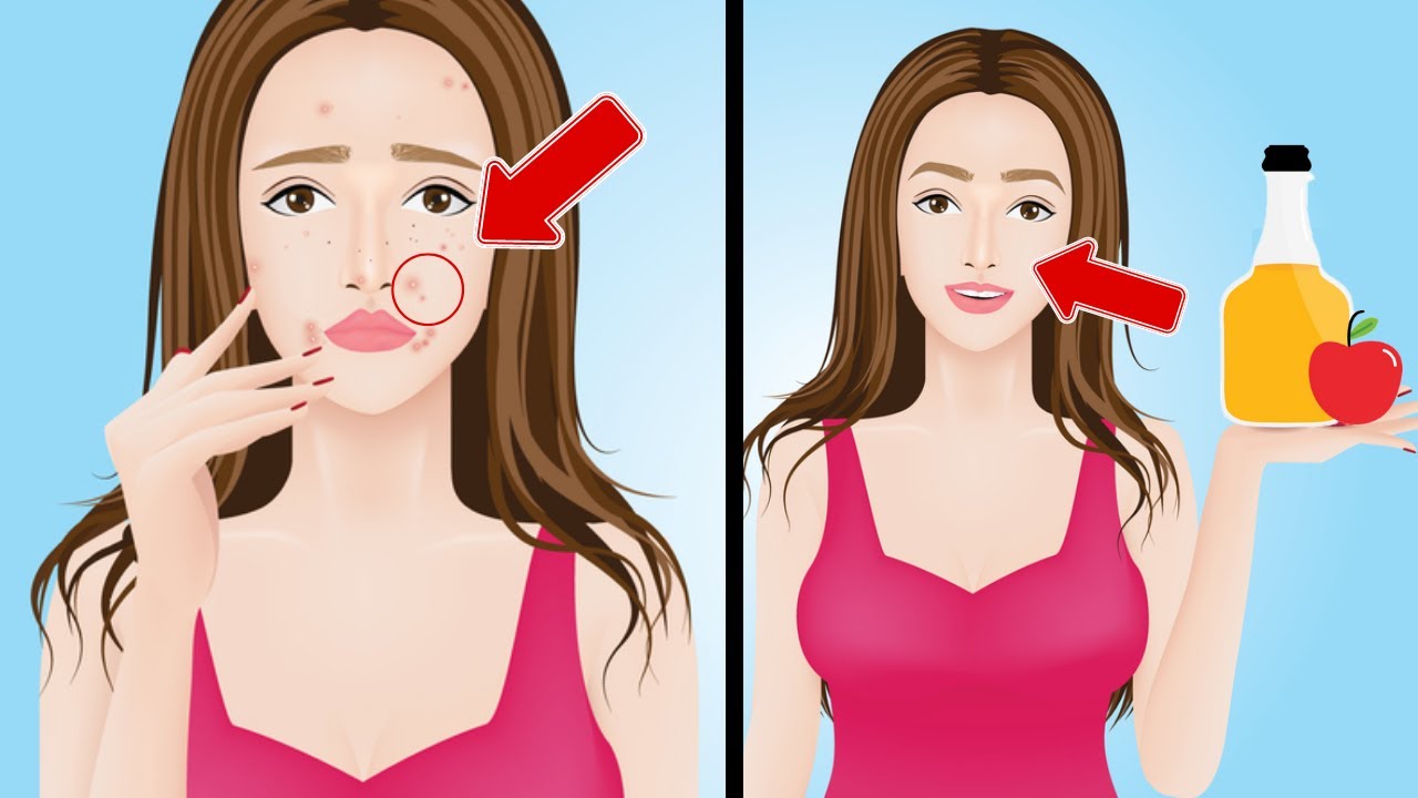 👉 How to Remove Acne with Apple Cider Vinegar YouTube