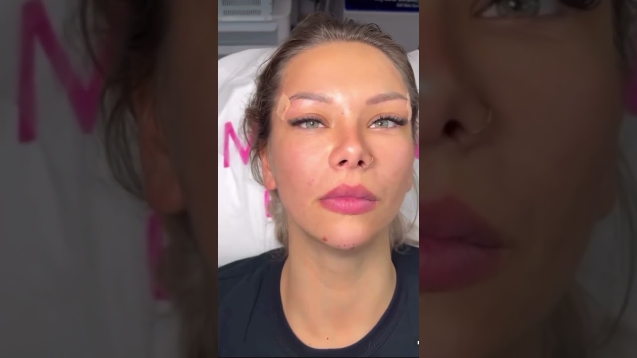 Процедура «лисьи глазки» 