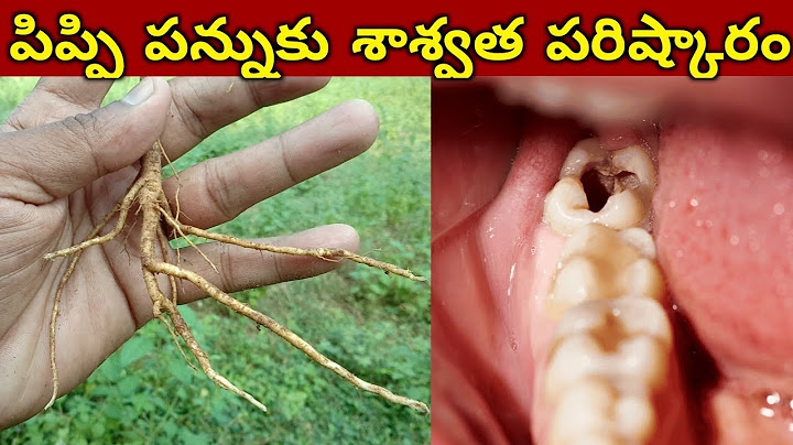 20 ఏళ్ల నుండి బధిస్తున్న పిప్పి పన్ను అయినా సరే 2 నిమిషాల్లో మాయం || How To cure cavities