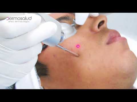 Eliminar el acne con Láser Fotona - Clínica Dermosalud