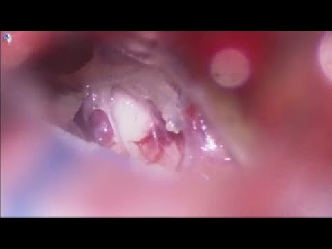 Video operatorio: conflitto neurovascolare nella nevralgia del trigemino — clicca per guardare