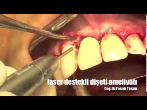 Dişeti ve ortodonti tedavisi