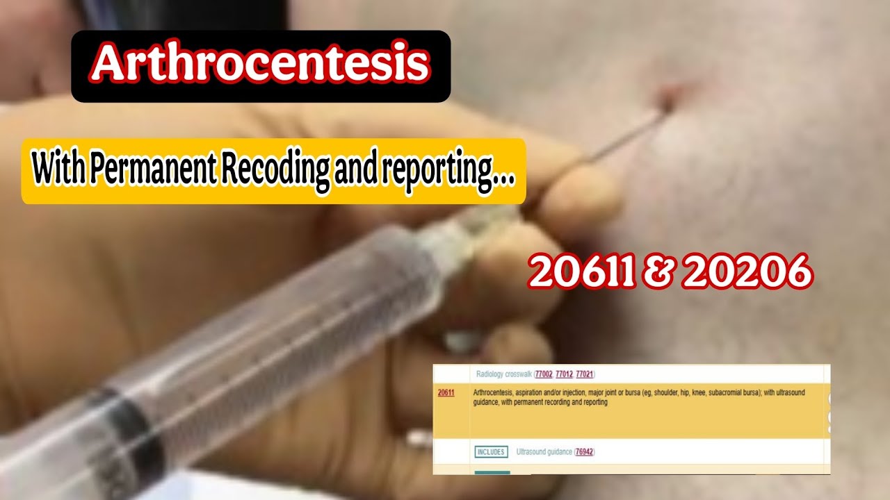 Arthrocentesis 20611 and 20606 || #arthrocentesis #procedure ...