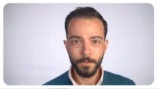 Yafpro - Protocol Scars And Pores With Microcysts Treatment - Phase 3 - Men, Normal To Oily