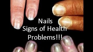 Nails Signs Of Health Diseases- SheCare