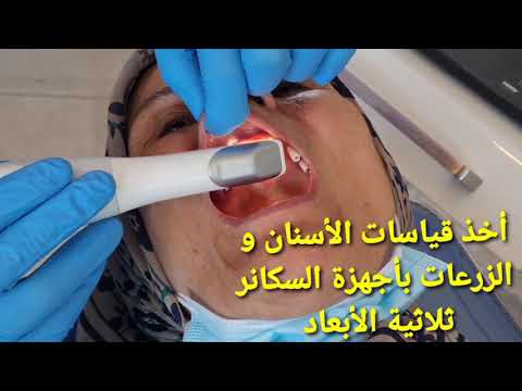 قياس تلبيس زرع الأسنان رقميآ   3      