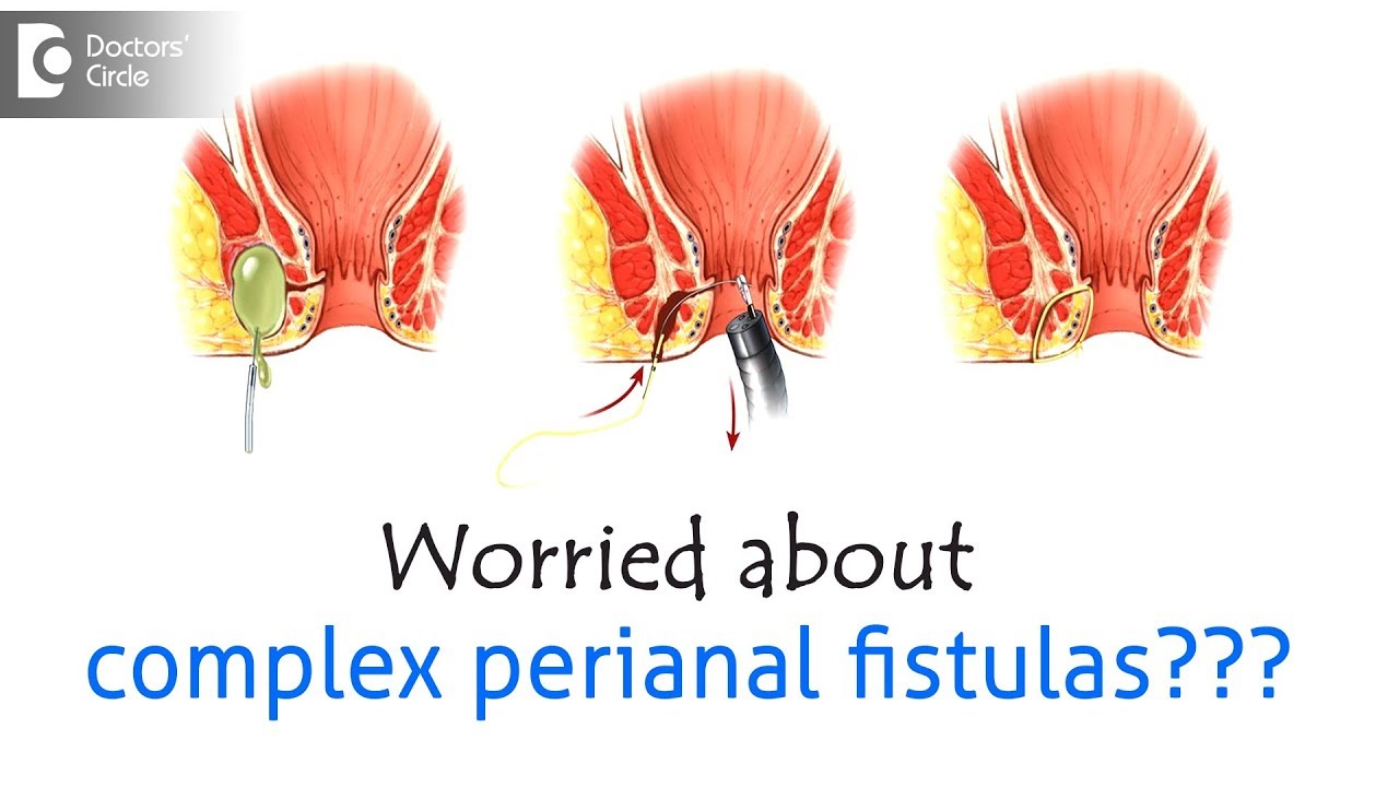 With perianal fistulas