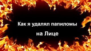 Как Я Удалял Папилломы На Лице. Процесс Удаления И Результаты