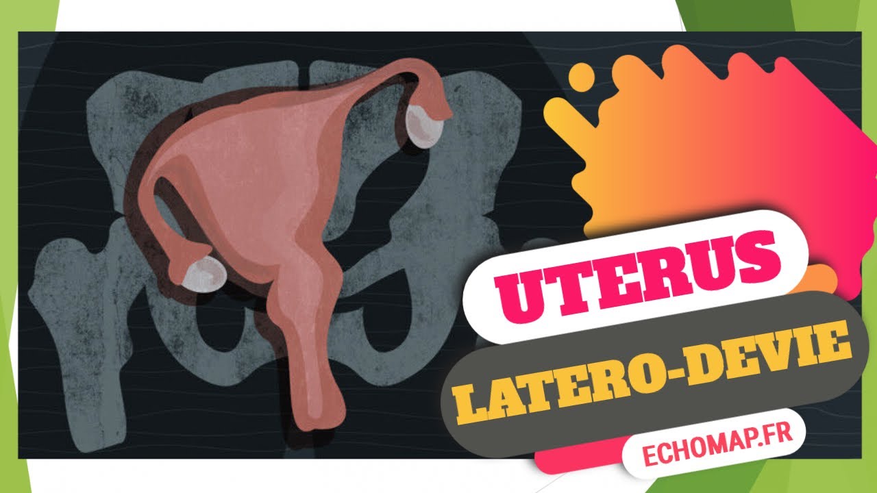 Utérus en échographie: latérodéviation