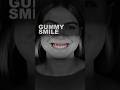 #GummySmile Correction with Botox – Reveal a More Balanced Smile in Just 14 Days!