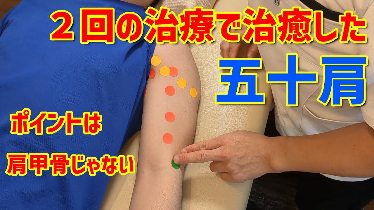 ２回の治療で治癒した半年動かせなかった五十肩（肩関節周囲炎）の症例の解説とアプローチの実演　A case of healing of immobile shoulder periarthritis