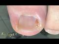 Adolescente cortando a unha de qualquer jeito - encaminha para o adolescente #satisfying #nails