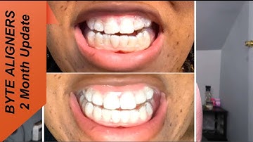 BYTE ALIGNERS 2 MONTH UPDATE | Ben and Cin
