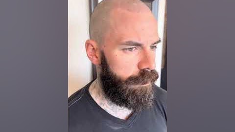 Experience the Transformation: Scalp Micro Pigmentation Session 2 - A Step Closer to a Head of Hair!