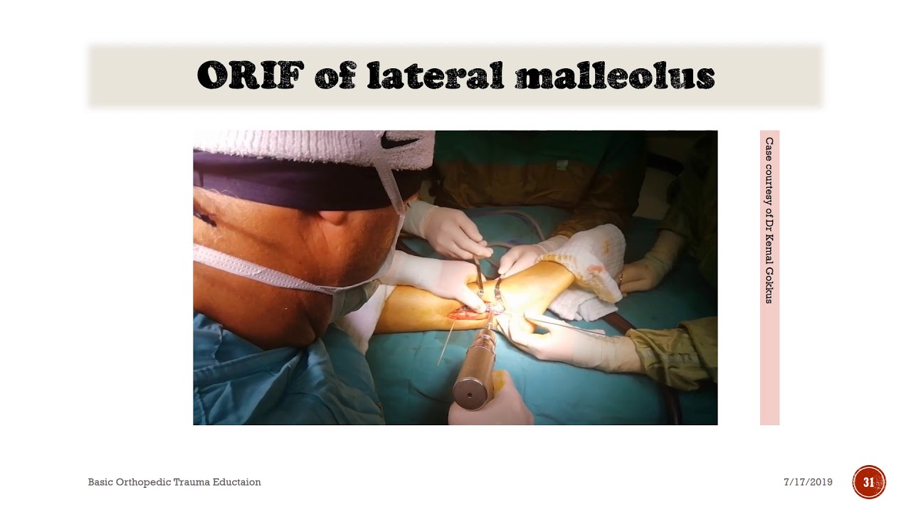 Ankle Fractures  and Syndesmosis Injuries    (A Brief Summary )