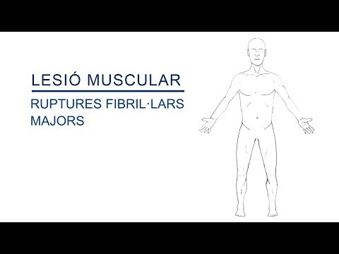 Vídeo: Són freqüents els desequilibris musculars?