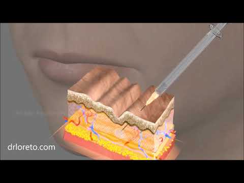 Injection d'acide hyaluronique - Bas du visage - Docteur Federico Loreto