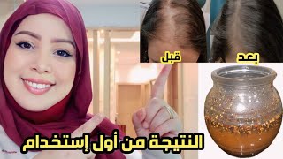 عندك فروة الرأس فارغة ومتضررة حضري علاج تساقط الشعر نهائيا خلال أسبوع طبيعي?4k