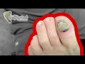 RAW AND JUICY TOE NAIL