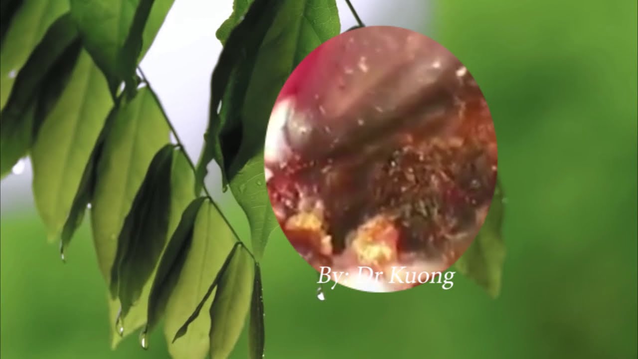 Internal audilogy cholesteatoma #28 - YouTube
