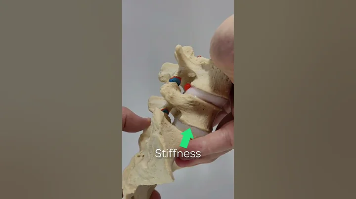 Dynamic Lumbar Model L4-sacrum demonstrating L5-1 height loss and stiffness with L4-5 herniation