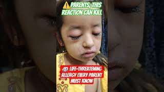 🙏 Life-Threatening Allergic Reaction Every Parent Must Know💔 #Anaphylaxis #hypersensitivity #Allergy