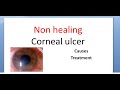 Ophthalmology 114 a Non healing corneal ulcer Cornea Causes Treatment