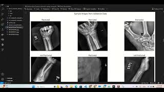 Detecting bone fracture using X-ray images