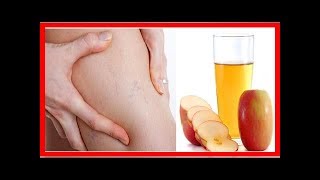Para vinagre varices manzana de