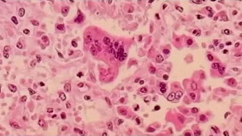 Measles cases reported in Texas as vaccine rate against the disease has fallen