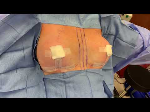 Breast Lift with Implant Downsizing Using Motiva Implants- Before and After!